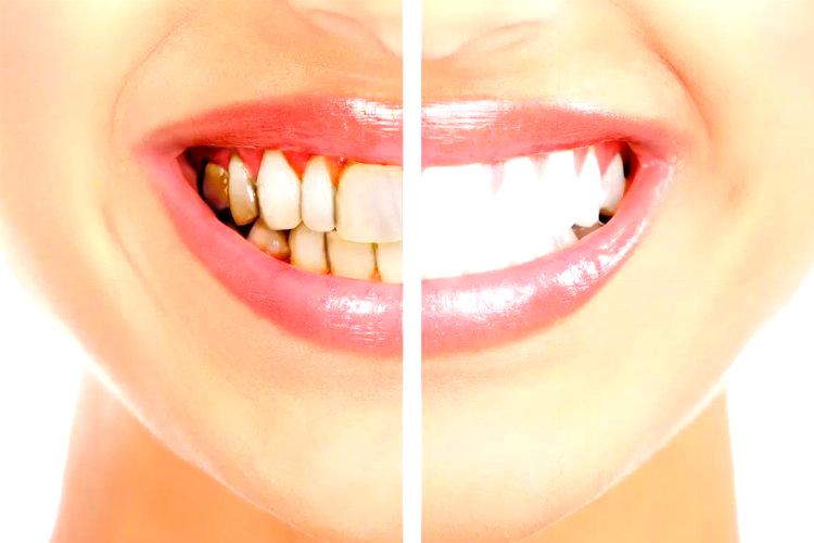 Diş taşı temizliğinin zararı var mı?